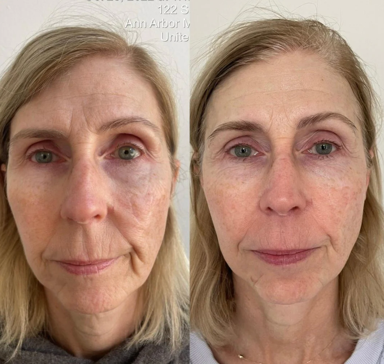 KrX Aesthetics Youthplex Face Lift Serum