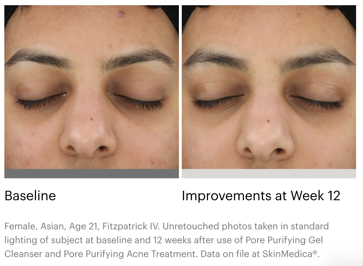 SkinMedica Pore Purifying Acne Treatment