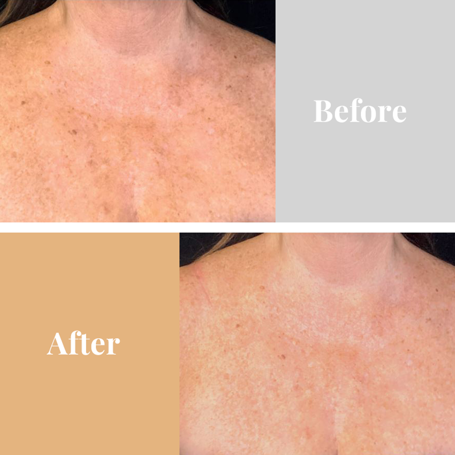 Omnilux Contour Neck & Décolleté Red Light Therapy Omnilux LED