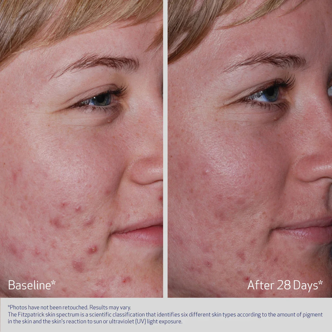 Obagi CLENZIderm M.D. Acne Therapeutic System
