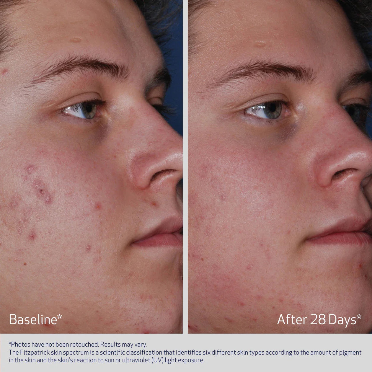Obagi CLENZIderm M.D. Acne Therapeutic System