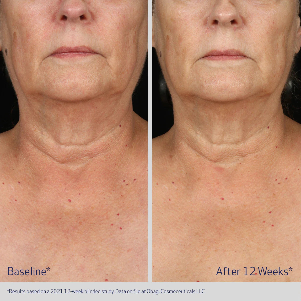 Obagi ELASTIderm Neck and Décolleté Concentrate
