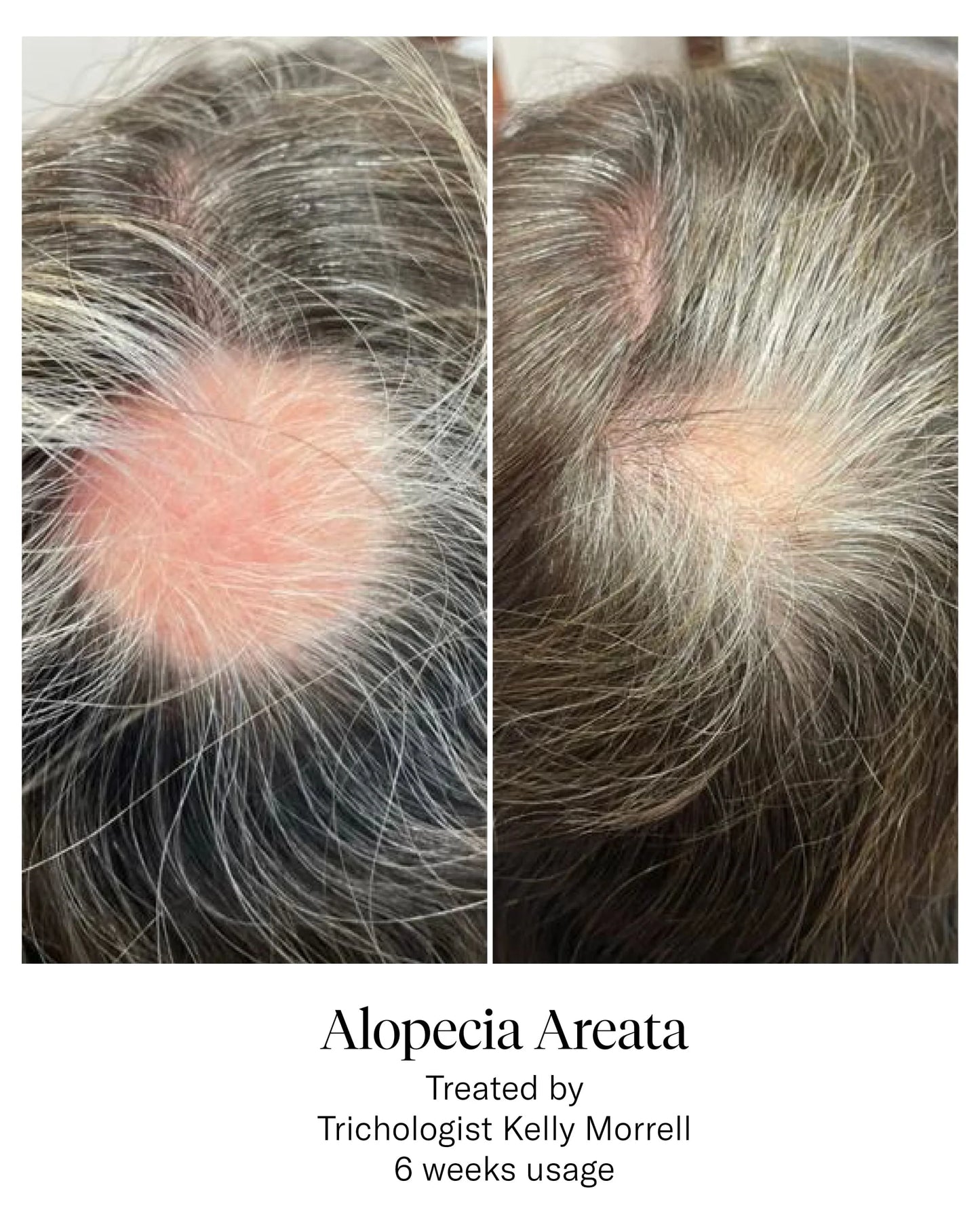 CALECIM Advanced Hair System