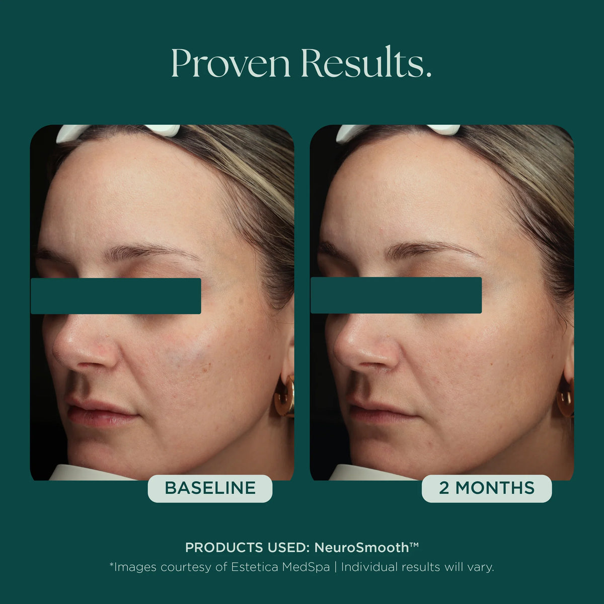 Marini SkinSolutions NeruoSmooth