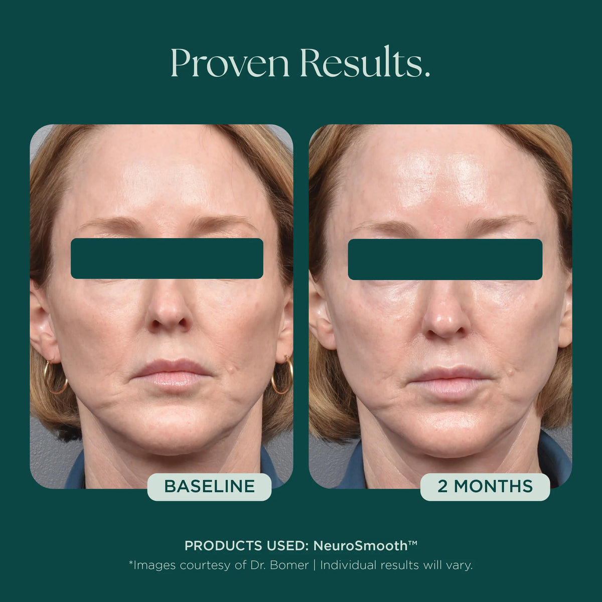 Marini SkinSolutions NeruoSmooth