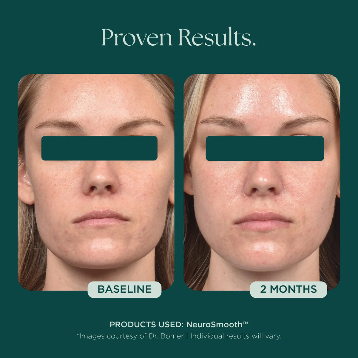Marini SkinSolutions NeruoSmooth