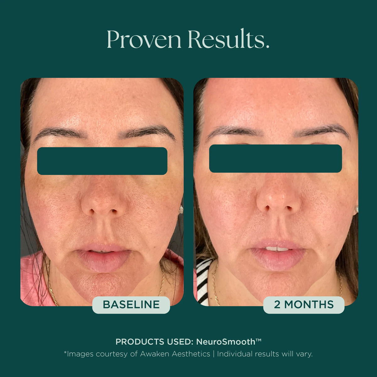 Marini SkinSolutions NeruoSmooth