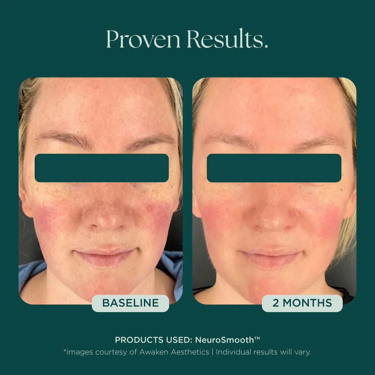 Marini SkinSolutions NeruoSmooth
