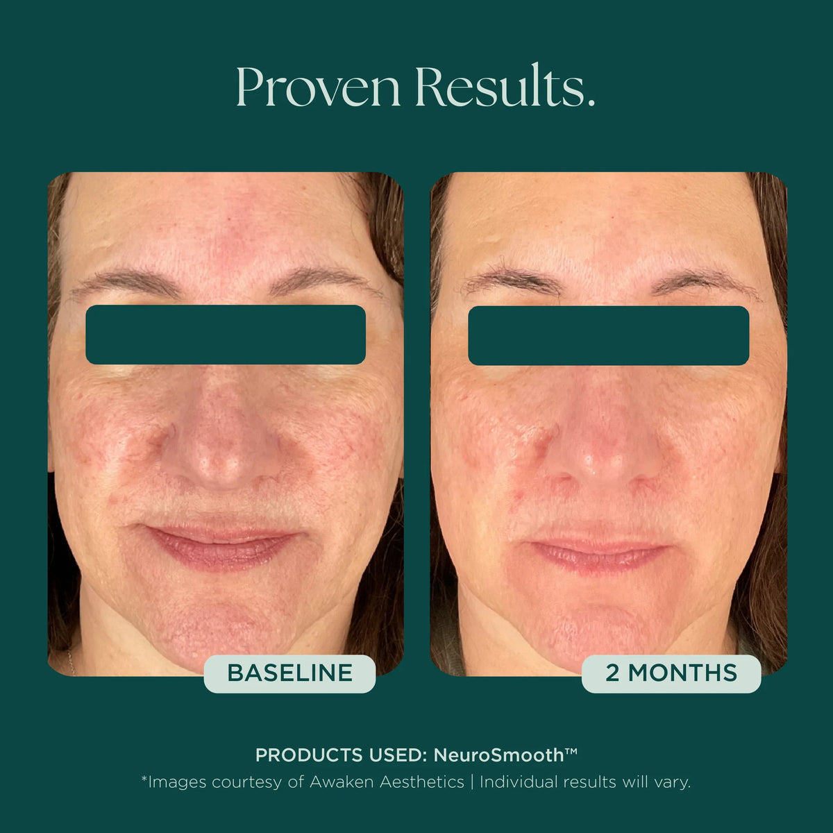 Marini SkinSolutions NeruoSmooth