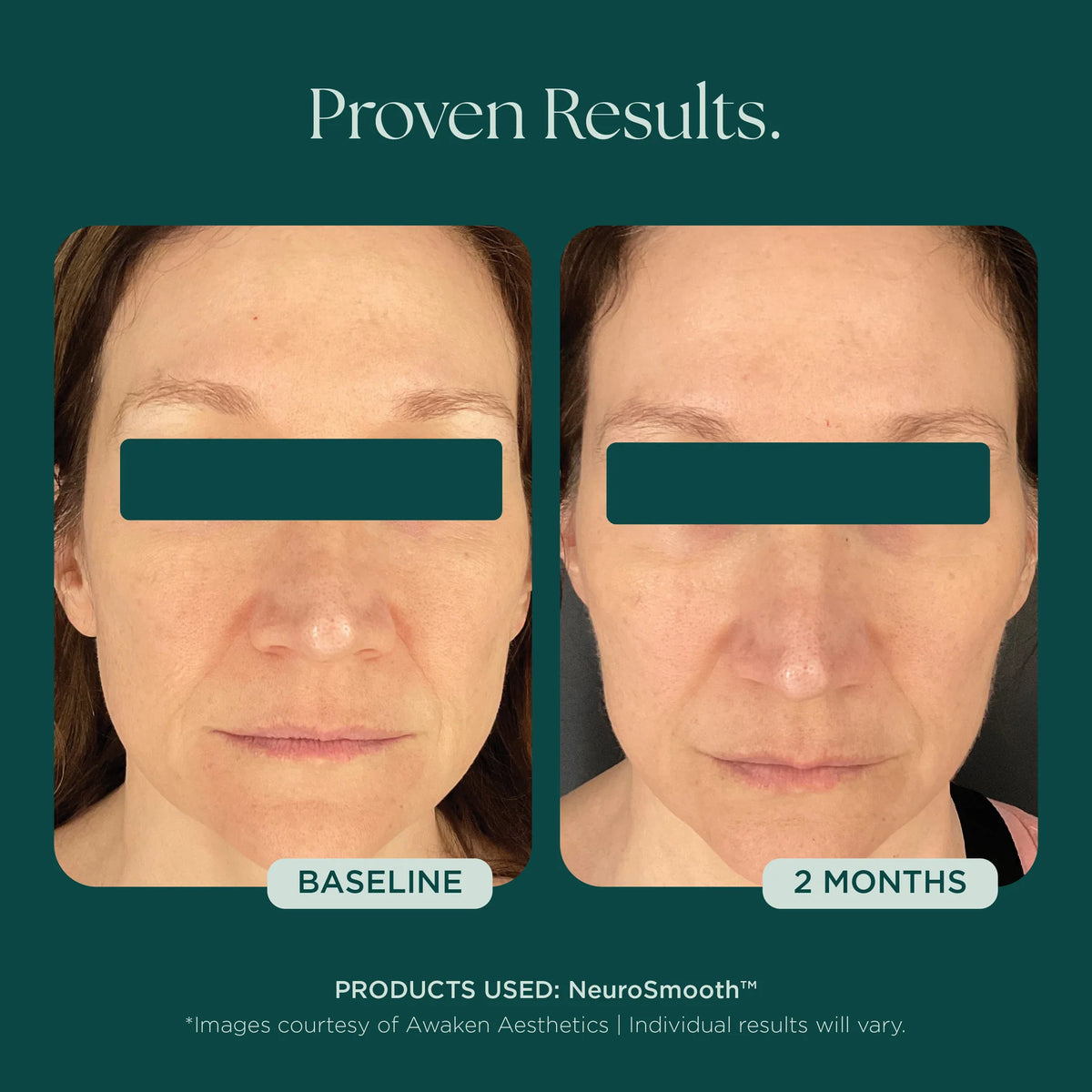Marini SkinSolutions NeruoSmooth