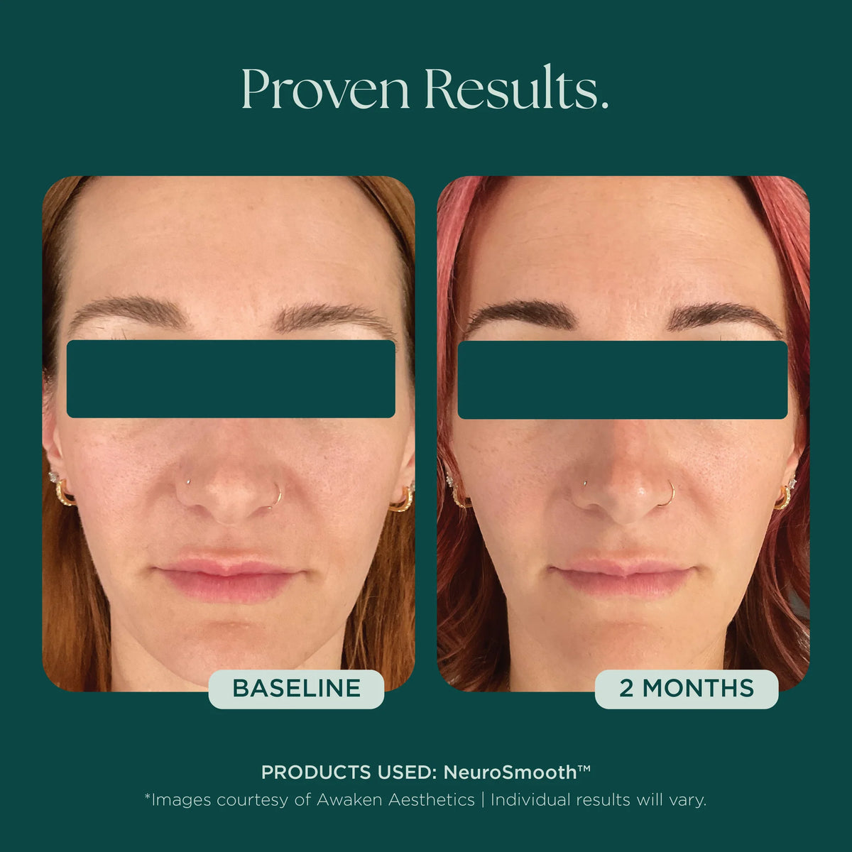 Marini SkinSolutions NeruoSmooth