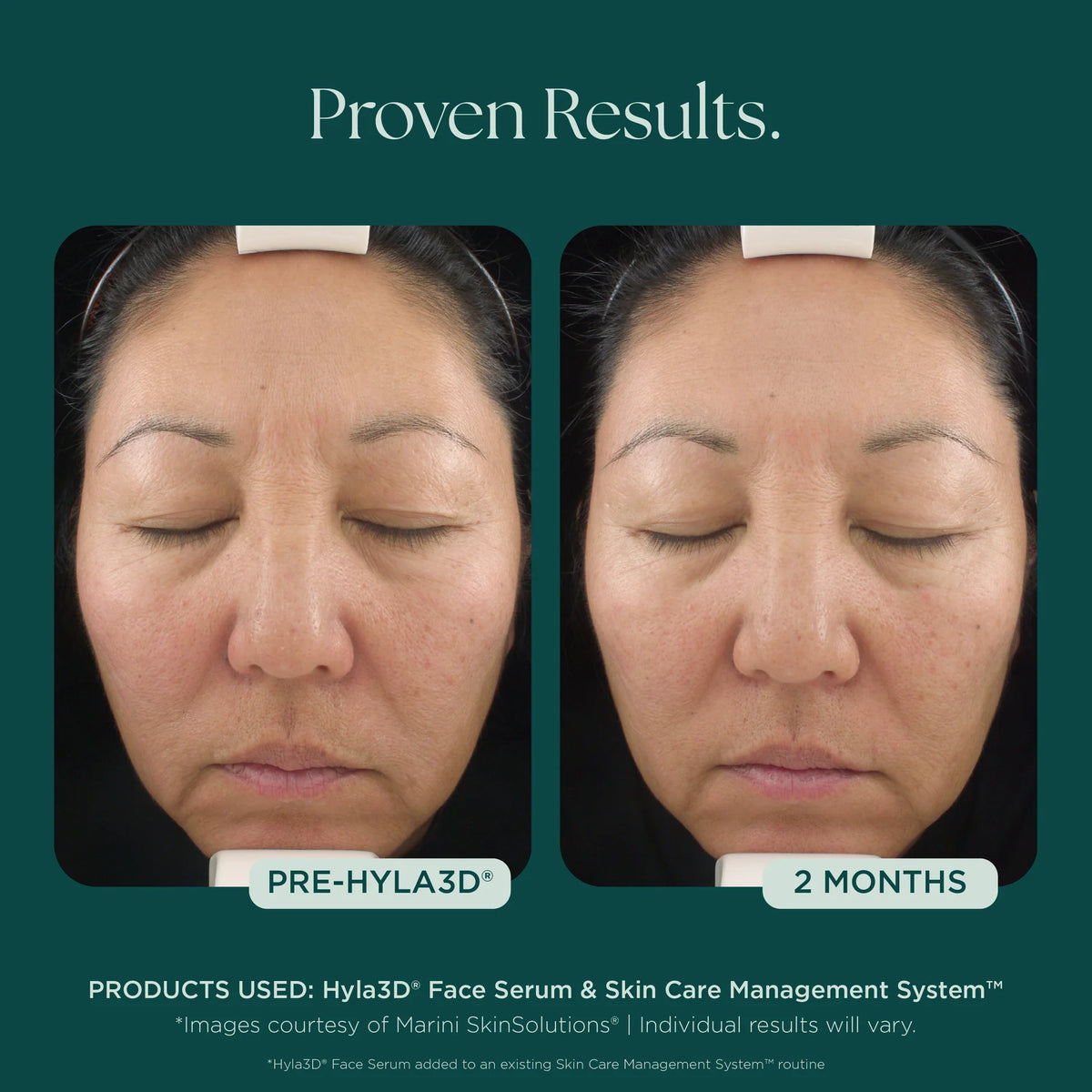 Marini SkinSolutions Hyla3D® Face Serum