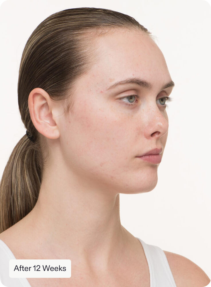 Nutrafol Clear Skin Nutraceutical Acne Treatments Nutrafol