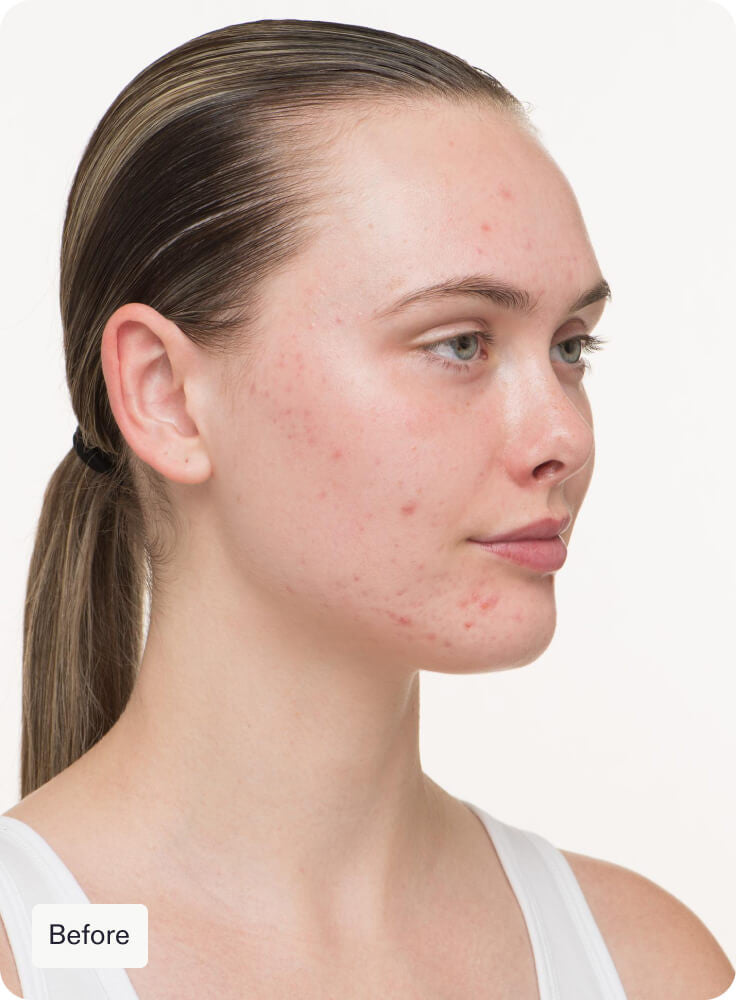 Nutrafol Clear Skin Nutraceutical Acne Treatments Nutrafol