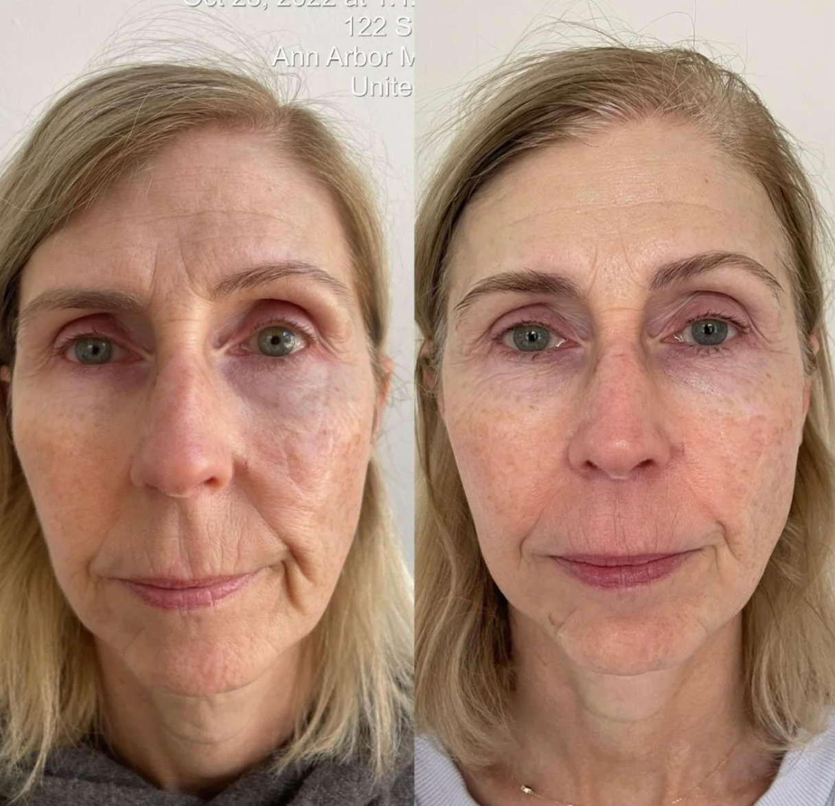 KrX Aesthetics Youthplex Face Lift Toning Solution