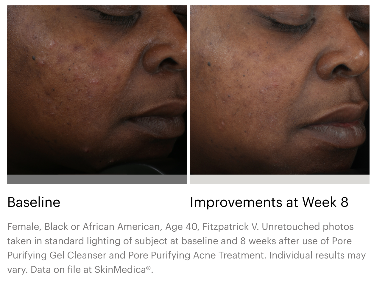 SkinMedica Pore Purifying Acne Treatment