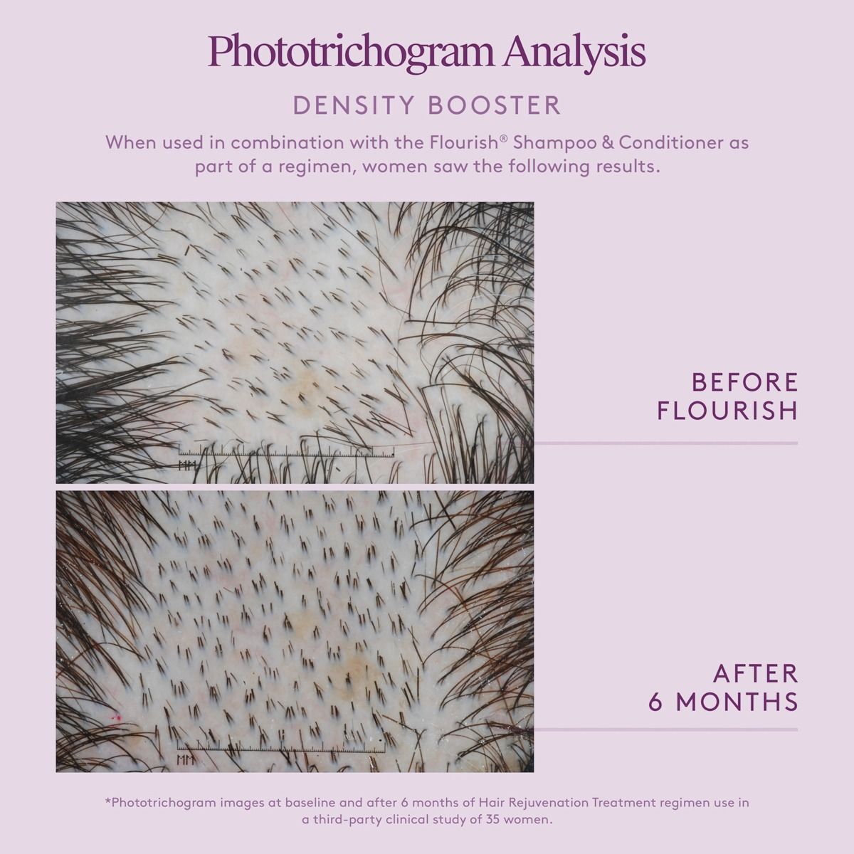 Phototrichogram analysis before and after using Flourish Shampoo & Conditioner, showing hair density improvement.